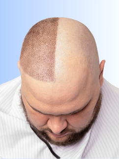 Hair Transplant