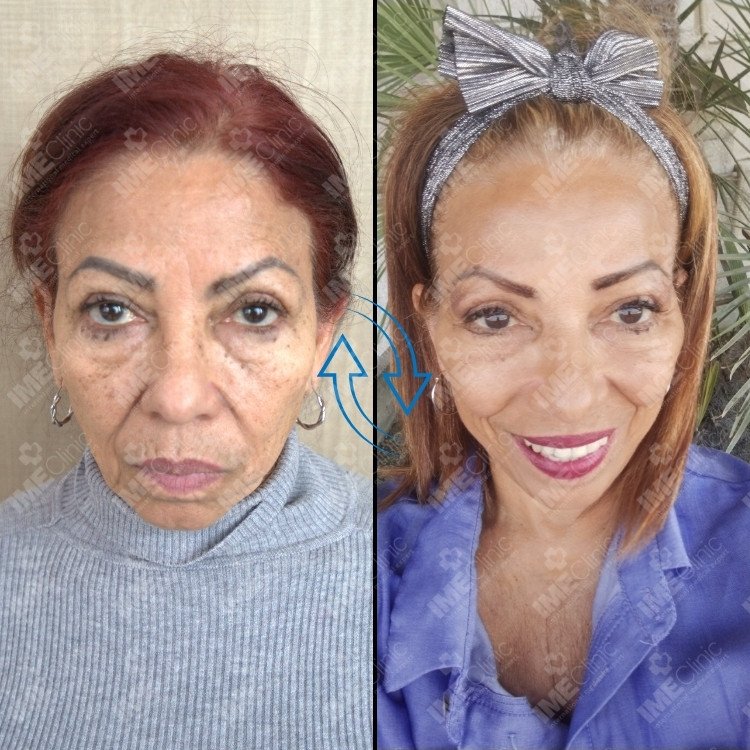 Lifting Facial + Lifting de Pescoço before and after, Prof. Dr. Emre Koçman