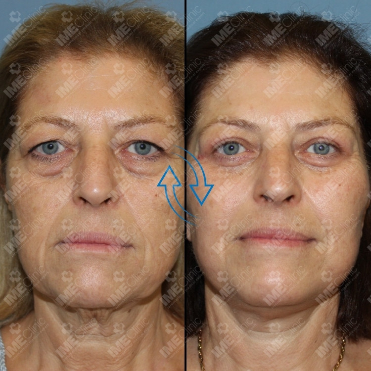 Facial rejuvenation result including the eye area, Istanbul