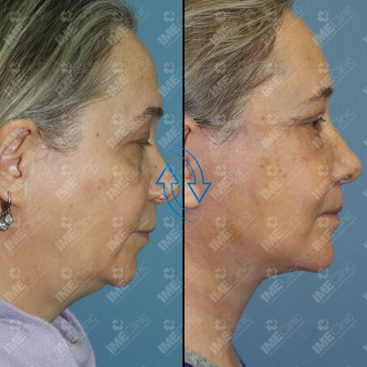 Lifting Facial + Lifting de Pescoço side profile before and after, Istanbul