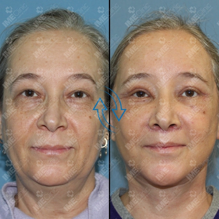 Facial rejuvenation front view before and after, Prof. Dr. Emre Koçman