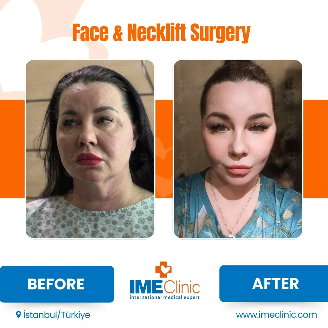 Front view before and after facelift by Prof. Dr. Emre Koçman, image 1