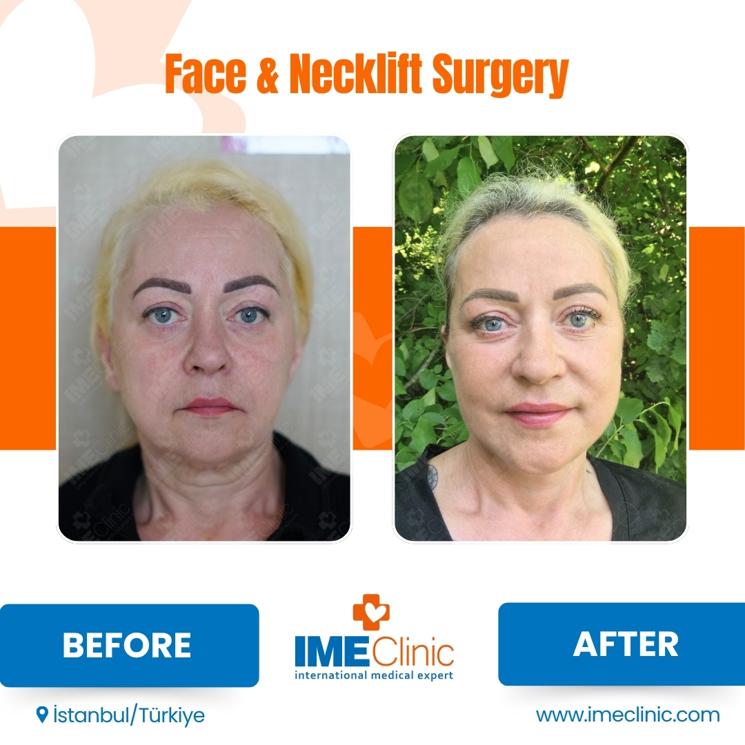 Front view before and after facelift by Prof. Dr. Emre Koçman, image 10