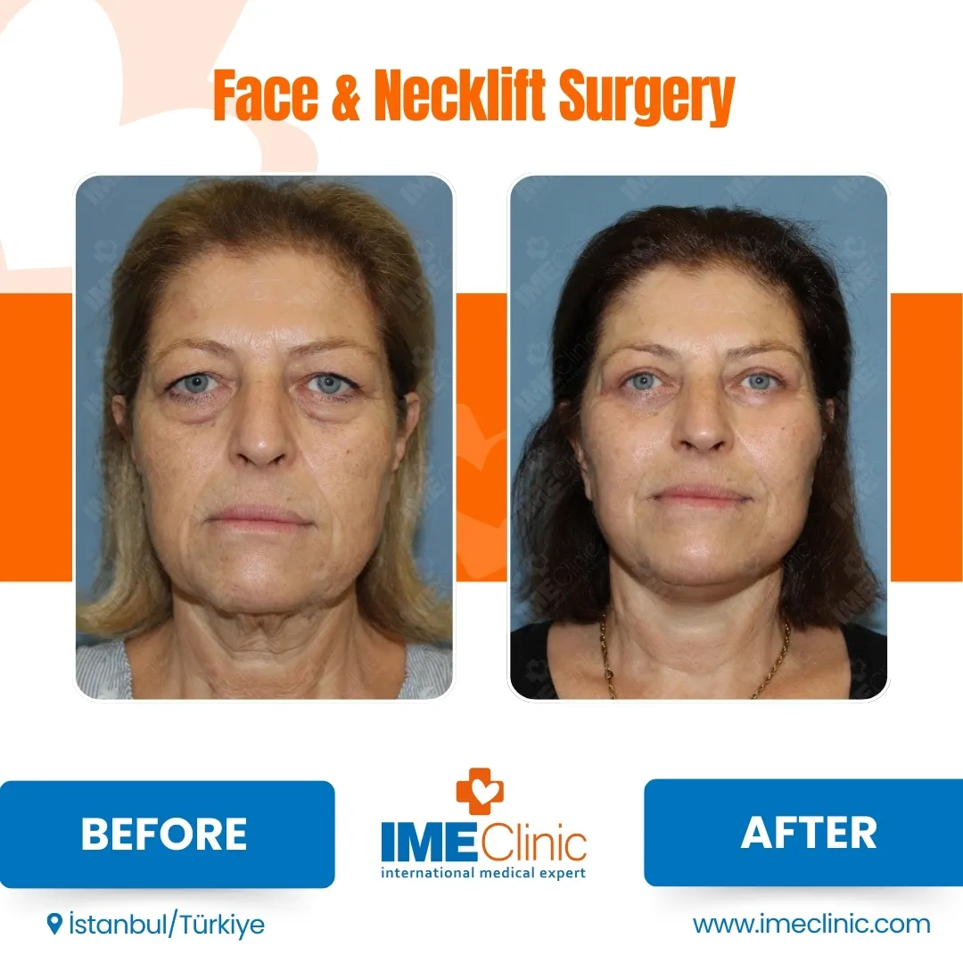 Front view before and after facelift by Prof. Dr. Emre Koçman, image 11