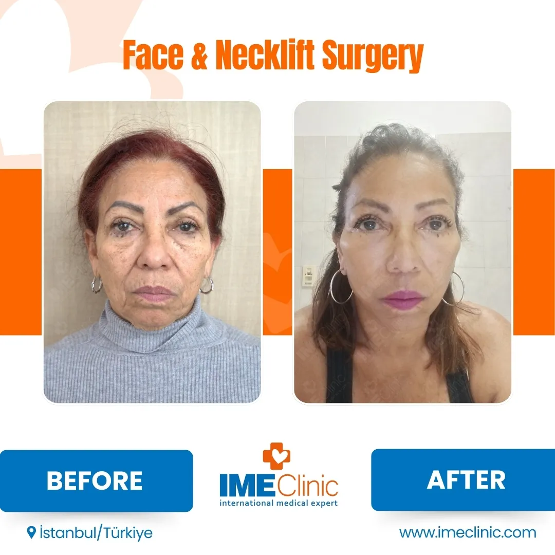 Front view before and after facelift by Prof. Dr. Emre Koçman, image 12