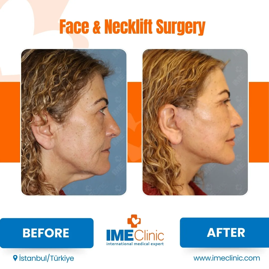 Front view before and after facelift by Prof. Dr. Emre Koçman, image 13