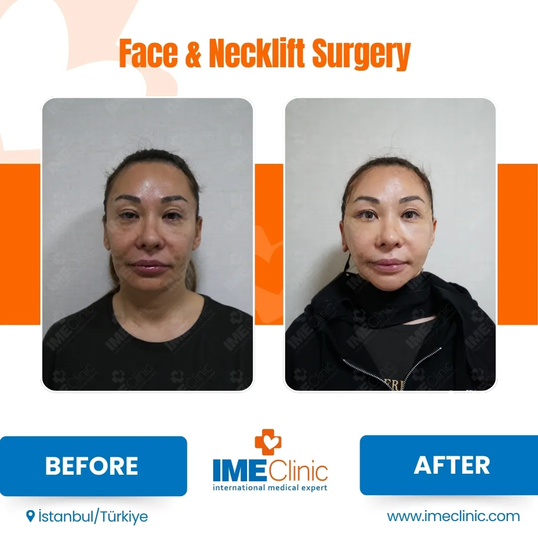 Front view before and after facelift by Prof. Dr. Emre Koçman, image 14