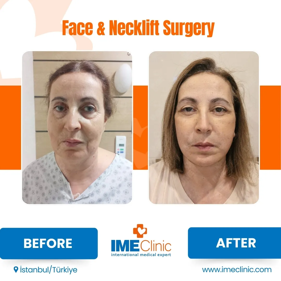 Front view before and after facelift by Prof. Dr. Emre Koçman, image 15