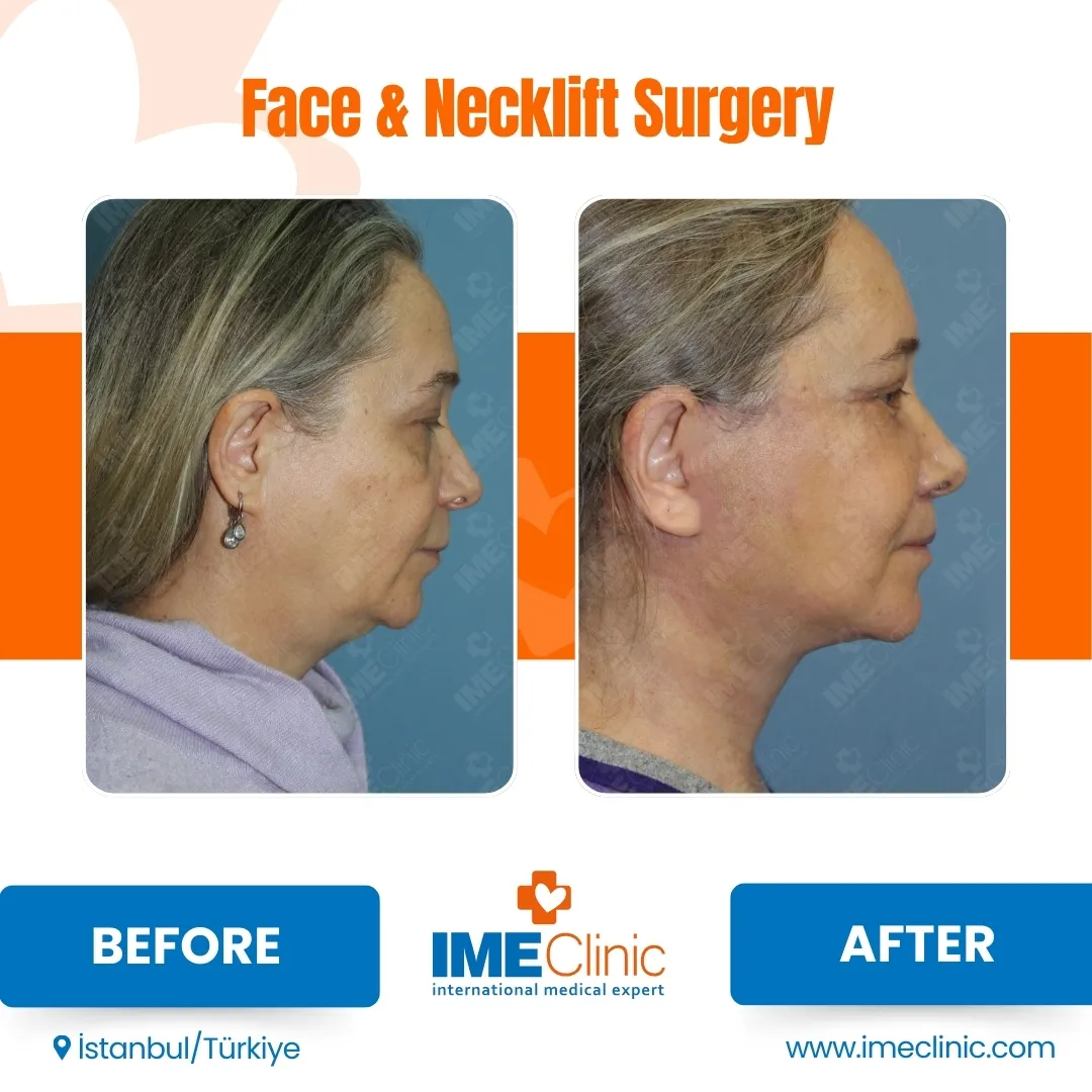 Front view before and after facelift by Prof. Dr. Emre Koçman, image 16