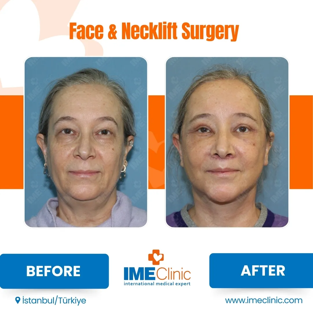 Front view before and after facelift by Prof. Dr. Emre Koçman, image 17