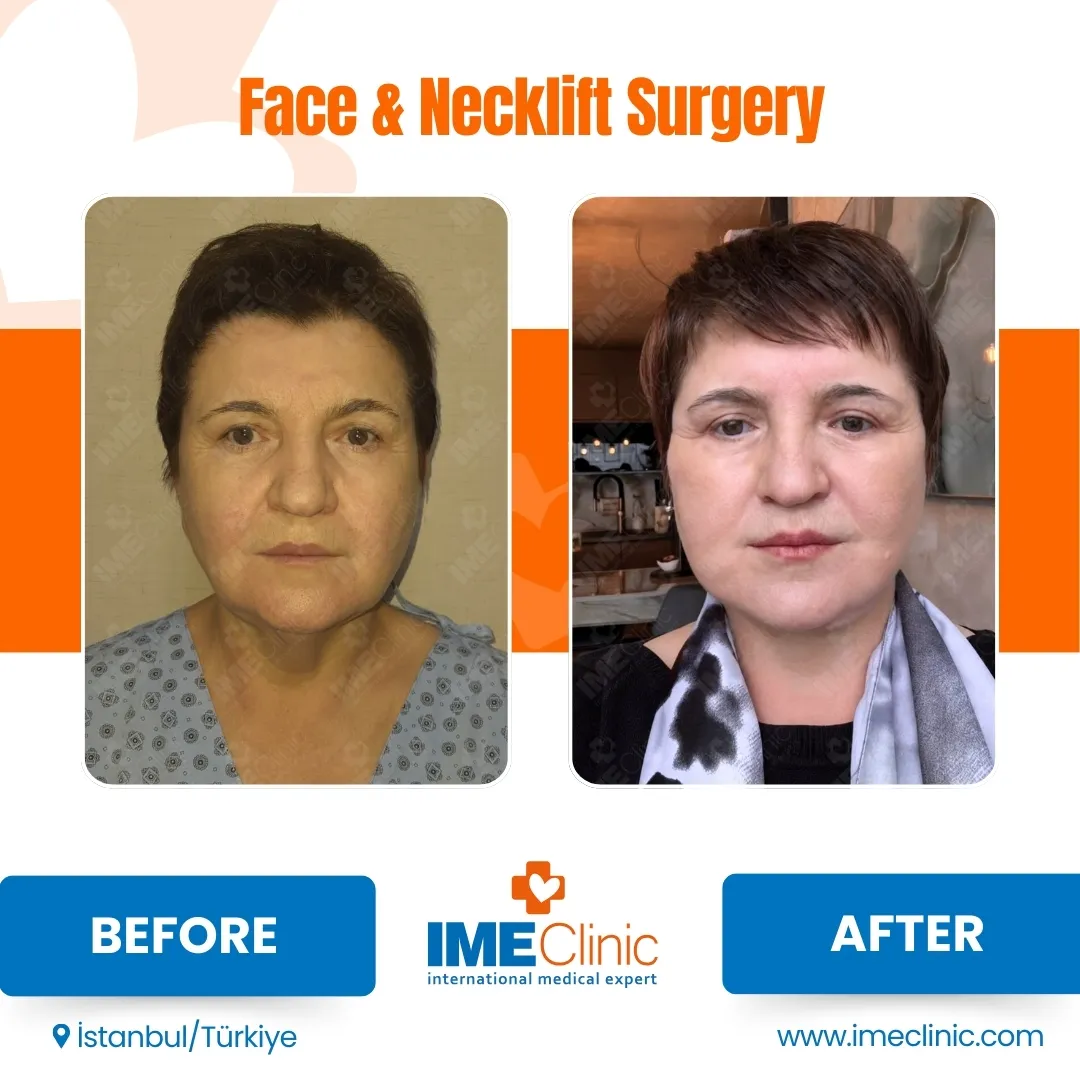 Front view before and after facelift by Prof. Dr. Emre Koçman, image 18