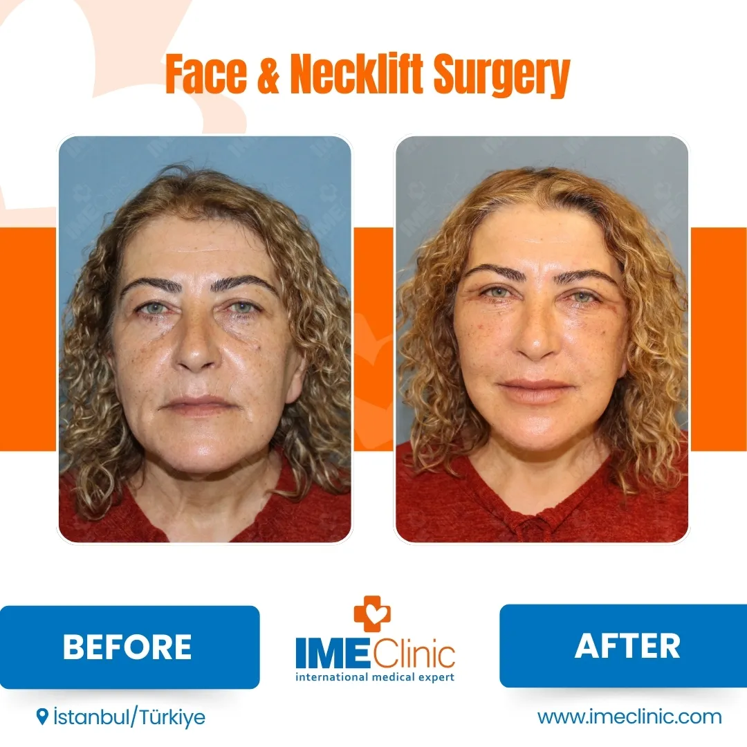 Front view before and after facelift by Prof. Dr. Emre Koçman, image 19