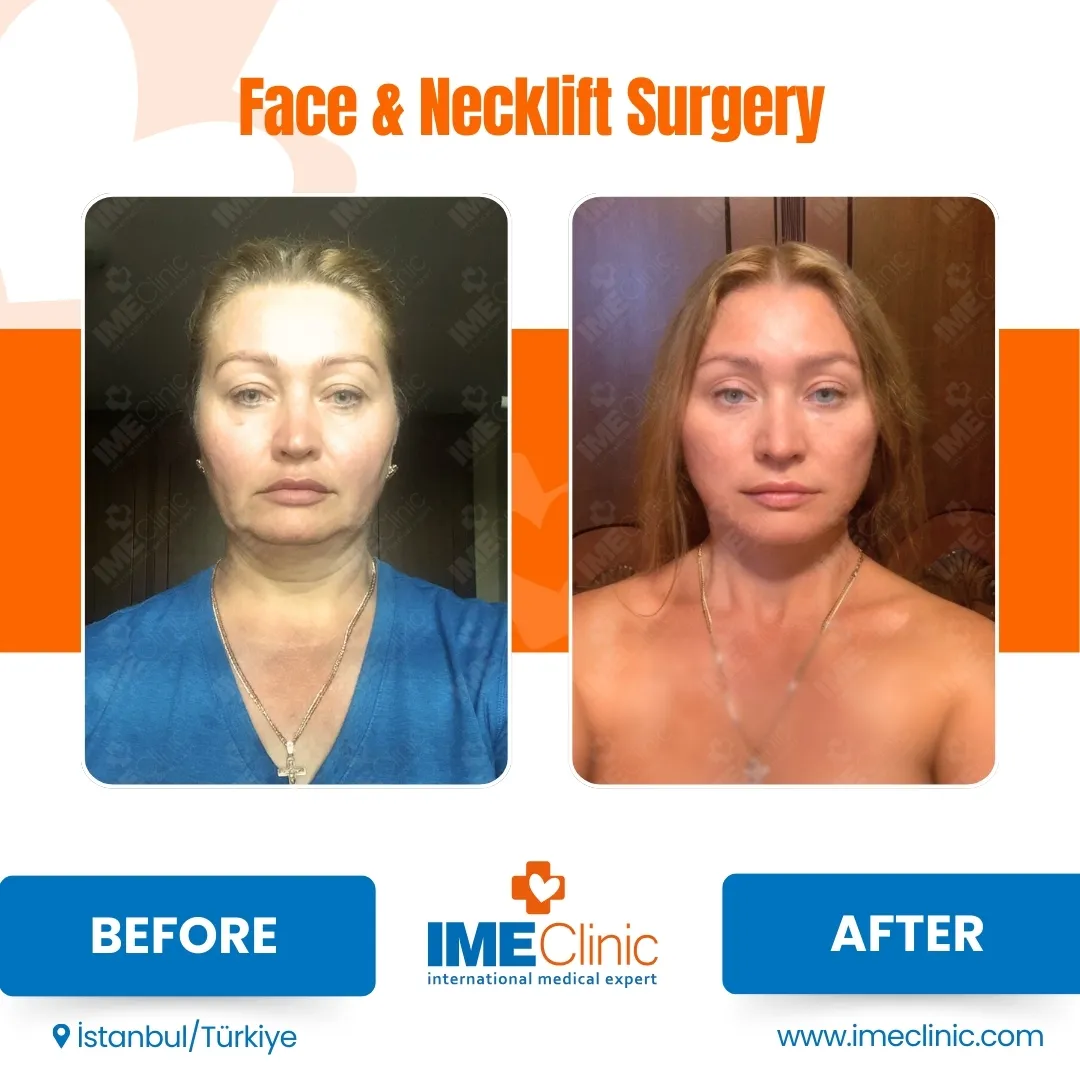Front view before and after facelift by Prof. Dr. Emre Koçman, image 2