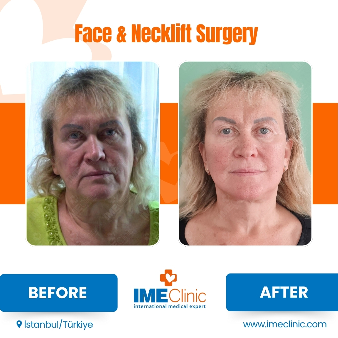 Front view before and after facelift by Prof. Dr. Emre Koçman, image 20