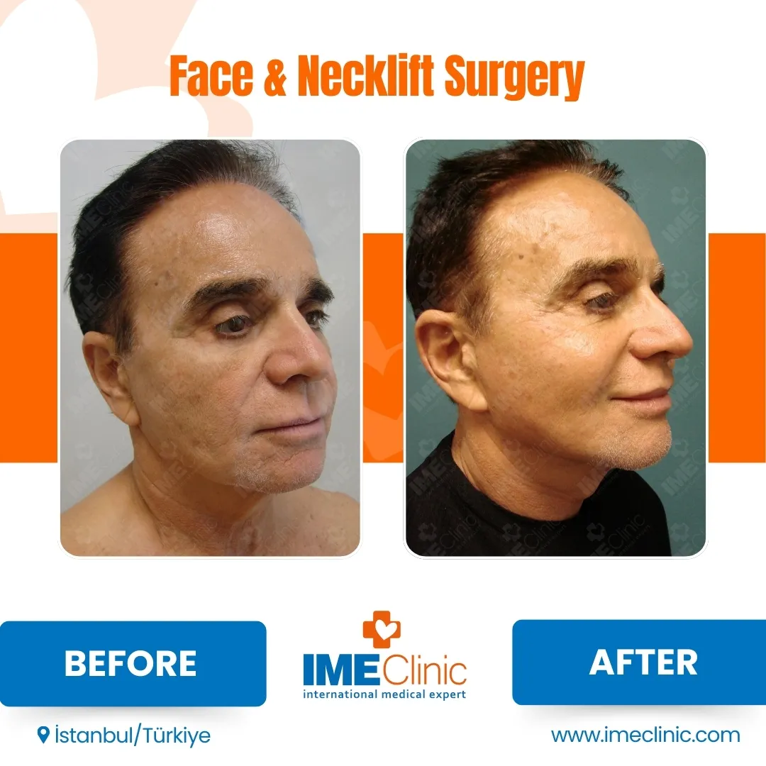 Front view before and after facelift by Prof. Dr. Emre Koçman, image 21