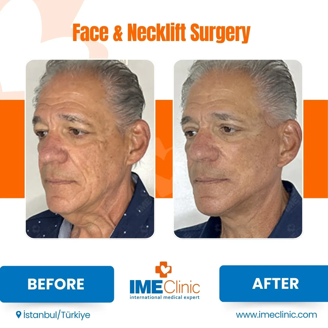 Front view before and after facelift by Prof. Dr. Emre Koçman, image 22