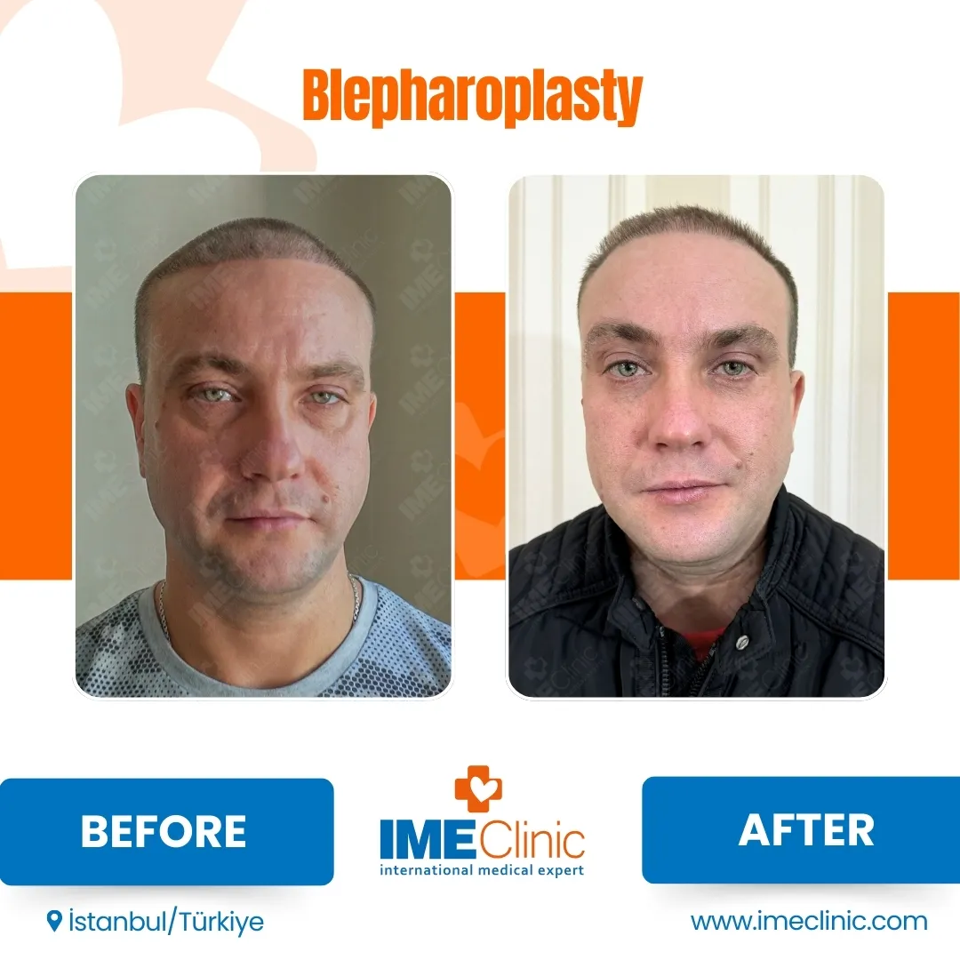 Front view before and after facelift by Prof. Dr. Emre Koçman, image 24