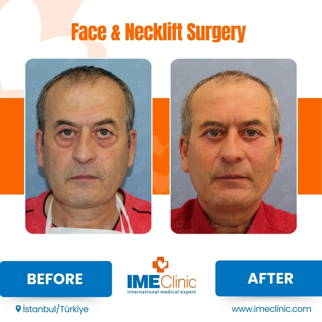 Front view before and after facelift by Prof. Dr. Emre Koçman, image 25