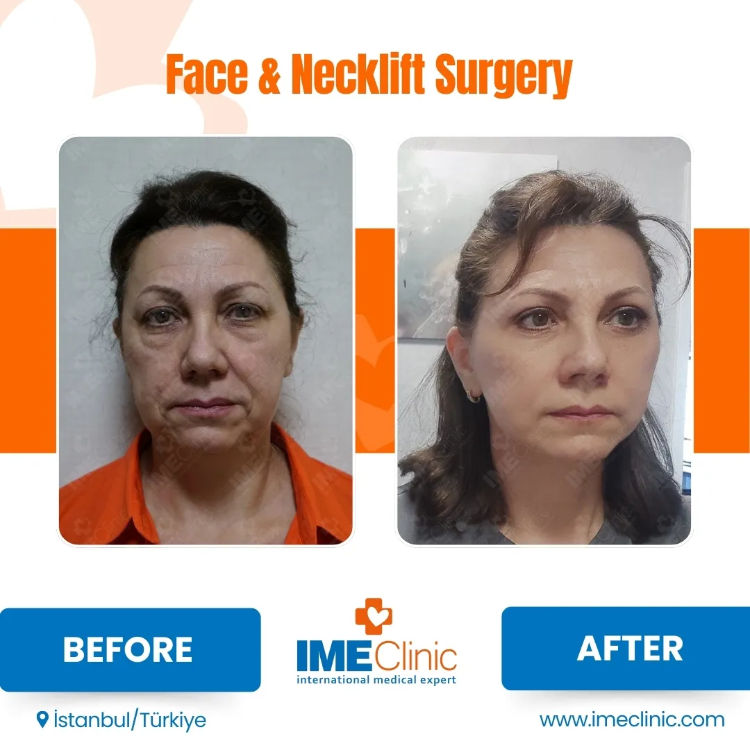 Front view before and after facelift by Prof. Dr. Emre Koçman, image 3