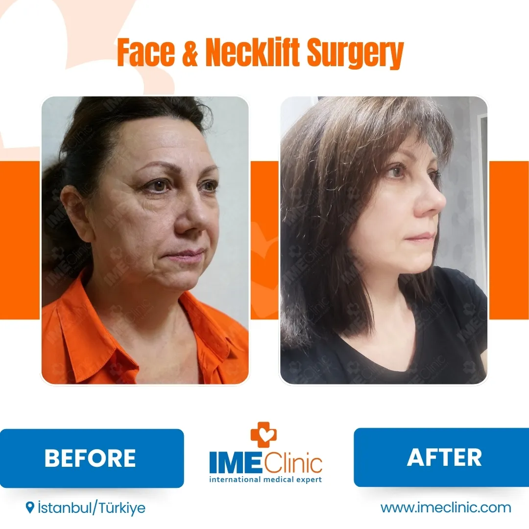 Front view before and after facelift by Prof. Dr. Emre Koçman, image 4