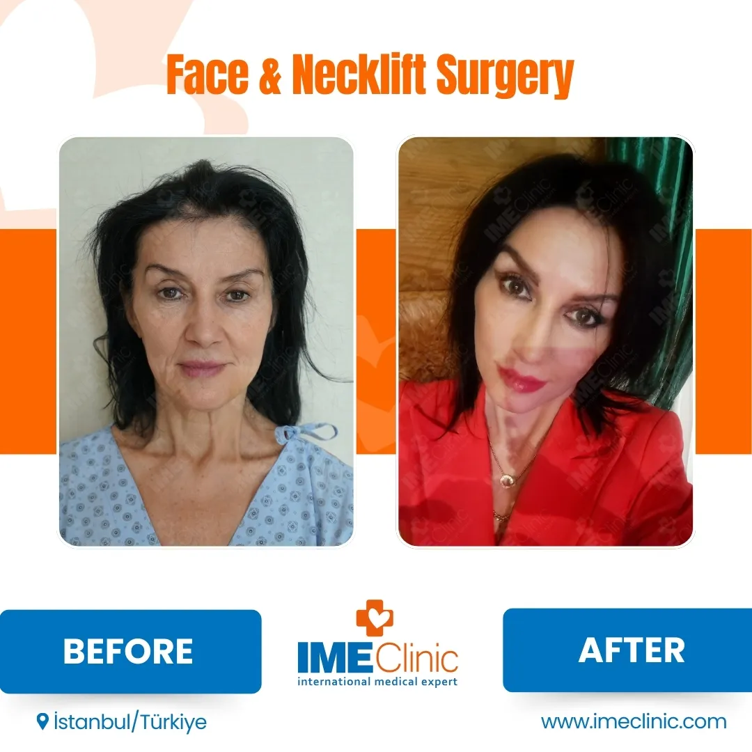 Front view before and after facelift by Prof. Dr. Emre Koçman, image 5