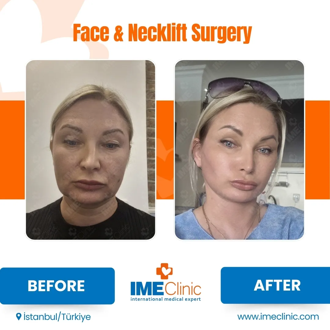 Front view before and after facelift by Prof. Dr. Emre Koçman, image 6