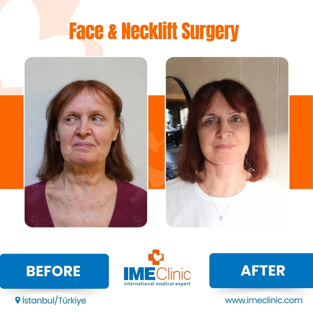 Front view before and after facelift by Prof. Dr. Emre Koçman, image 8