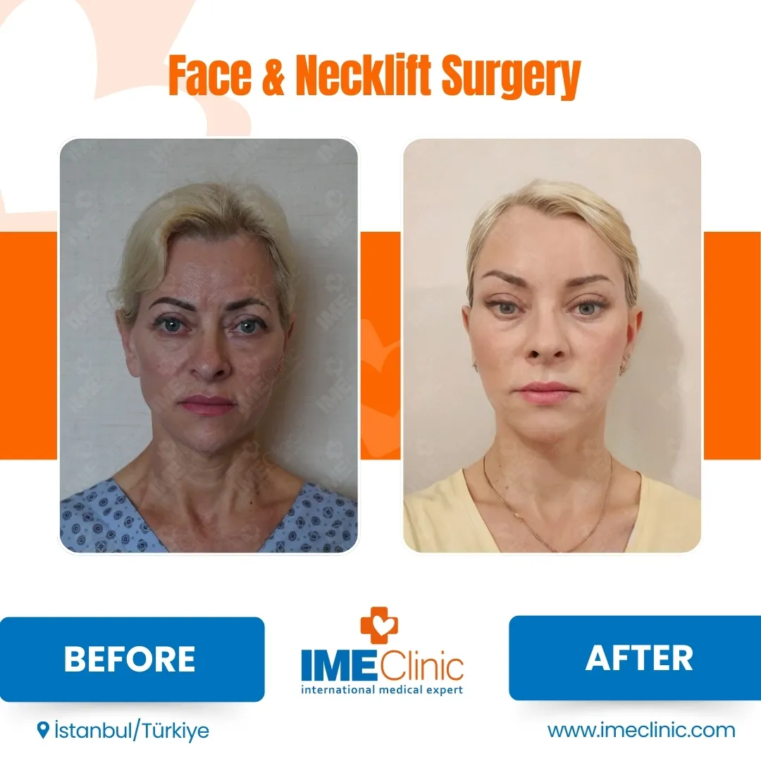 Front view before and after facelift by Prof. Dr. Emre Koçman, image 9