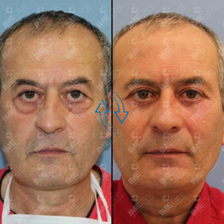 Cirugía de párpados (blepharoplasty) before and after, Prof. Dr. Emre Koçman
