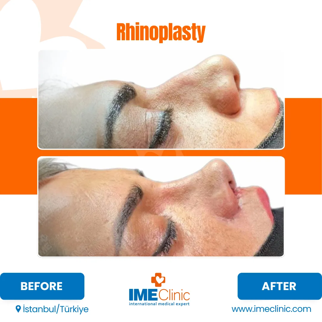 Close-up side view of a persons face showing the nose before and after rhinoplasty. Top image shows the nose before surgery; bottom image shows a straighter, reshaped nose after the procedure. Text and clinic branding included.