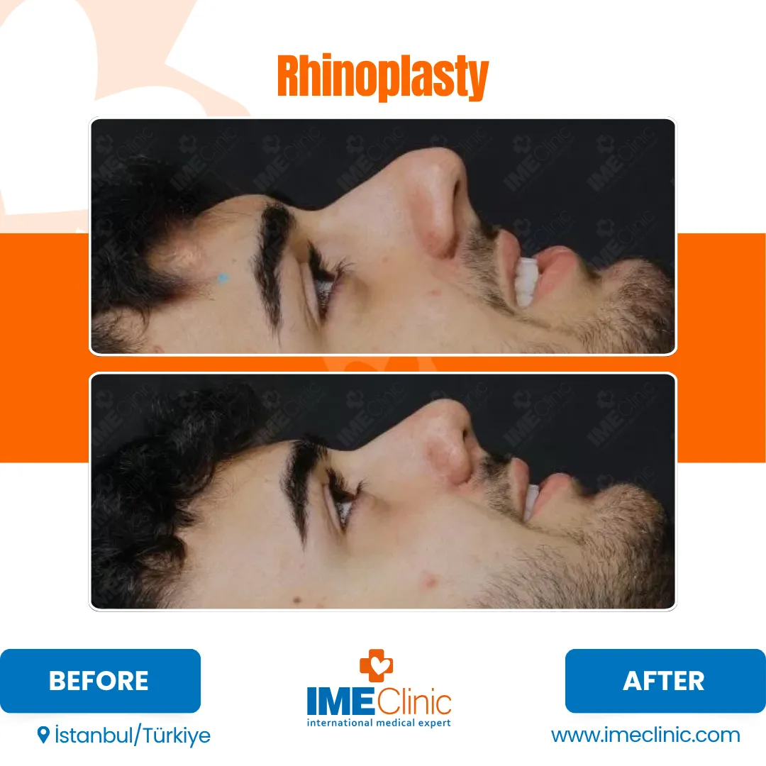 Side-by-side before and after photos of a mans face showing profile views of his nose after rhinoplasty. The after image shows a straighter and more refined nasal shape. Text reads Rhinoplasty and IME Clinic with location Istanbul, Turkey.