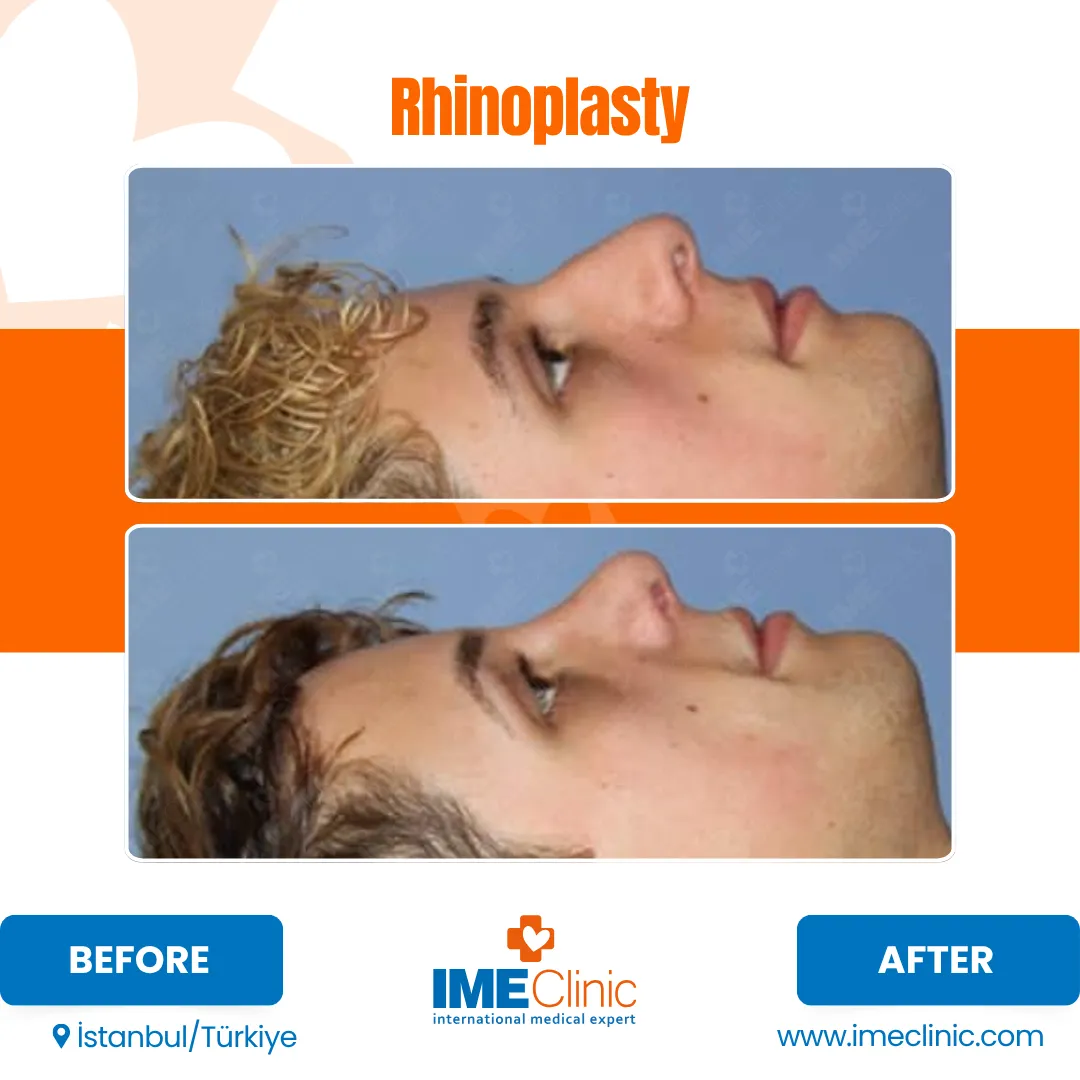 Before and after photos showcasing a gynecomastia transformation. The top image displays a fuller chest, while the bottom reveals a more contoured look. Text reads BEFORE and AFTER with IME Clinic branding, highlighting the powerful impact of specialized care.