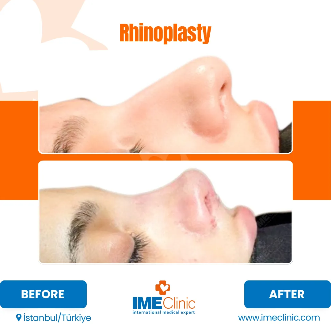 Side-by-side comparison of a persons profile before and after rhinoplasty surgery, showing a noticeable change in the shape and contour of the nose; Before and After labels are present.