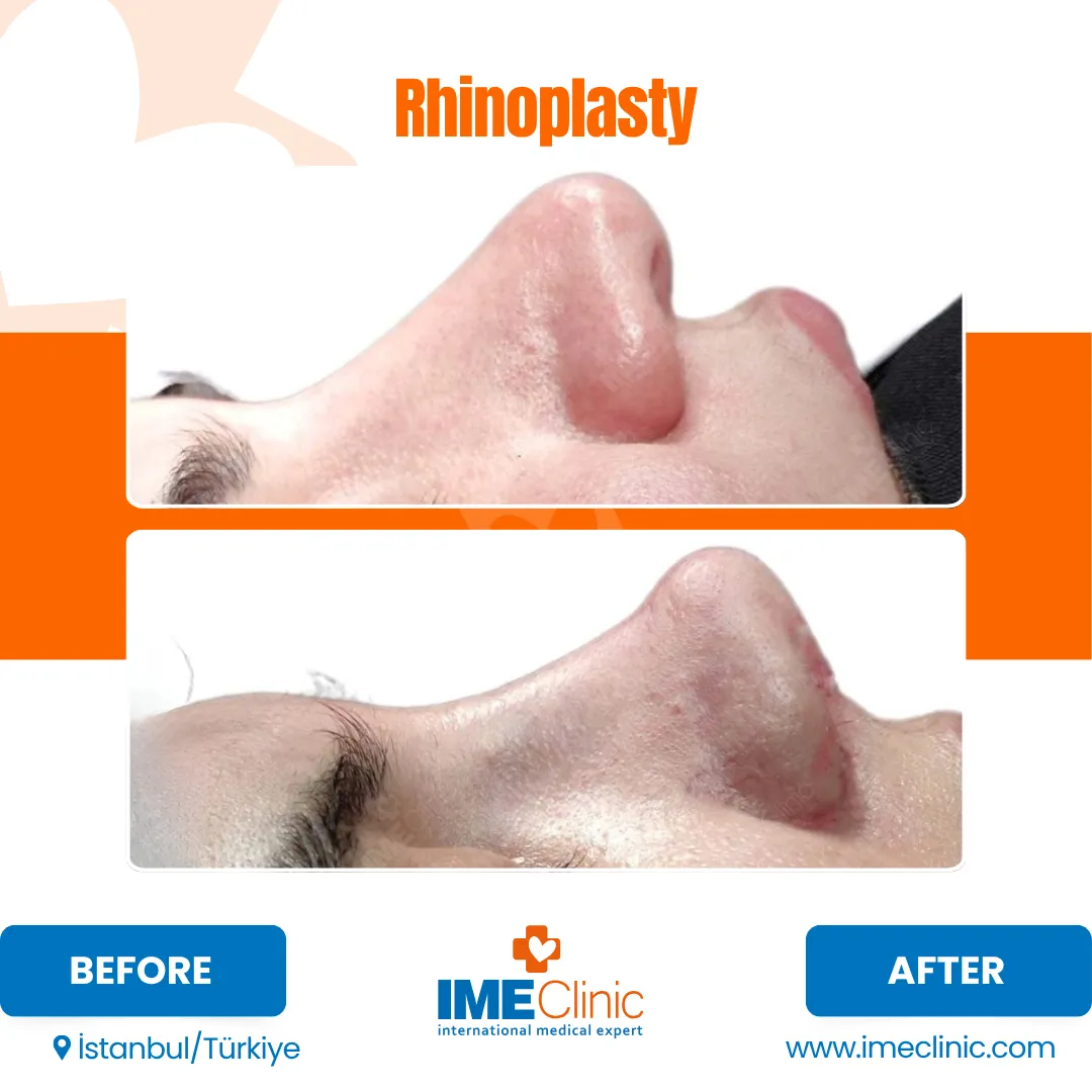 Before and after photos showcasing a gynecomastia transformation. The top image displays a fuller chest, while the bottom reveals a more contoured look. Text reads BEFORE and AFTER with IME Clinic branding, highlighting the powerful impact of specialized care.