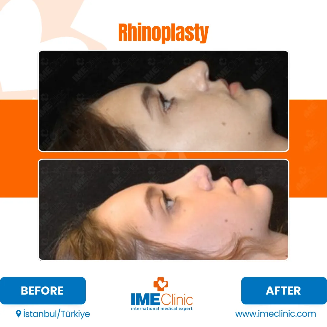 Side-by-side profile photos of a woman before and after rhinoplasty, showing changes in the shape of her nose. The top image is labeled before and the bottom image after. IME Clinic branding appears at the bottom.