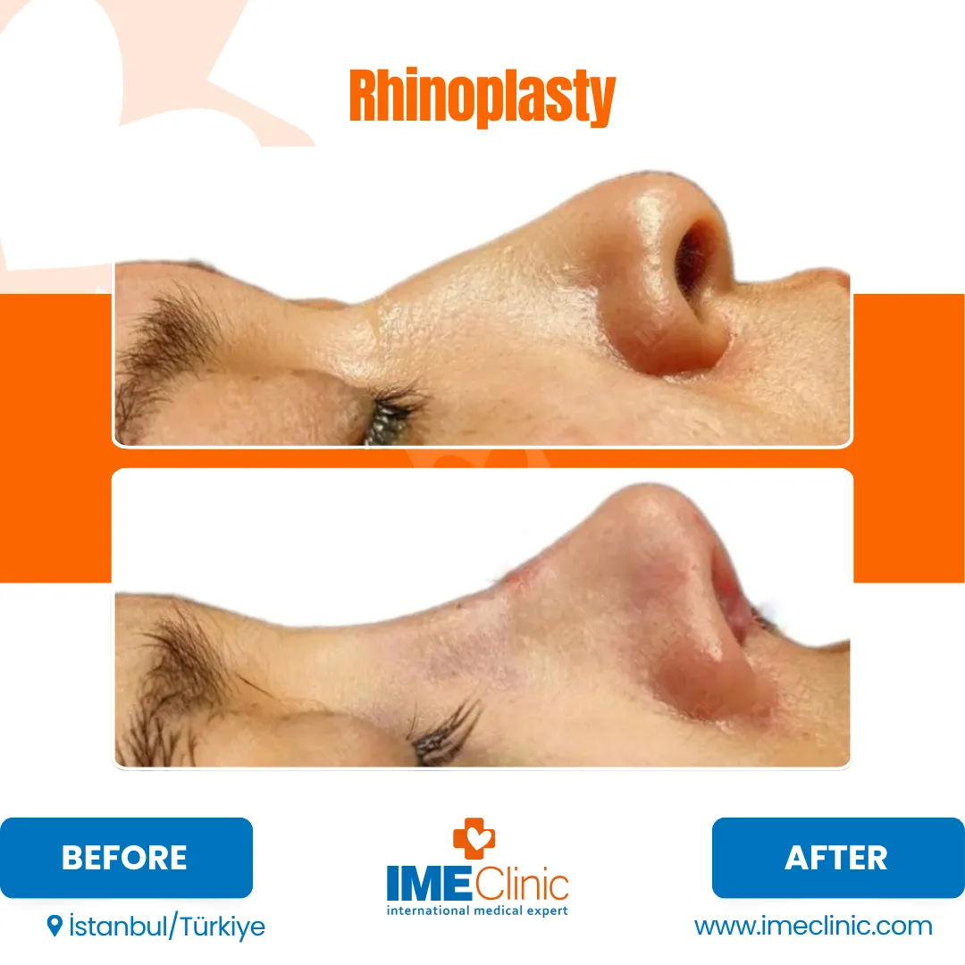 Side-by-side before and after photos of a persons nose profile showing visible changes following rhinoplasty surgery. The before image shows a more prominent nose, while the after image shows a slimmer, more refined shape.