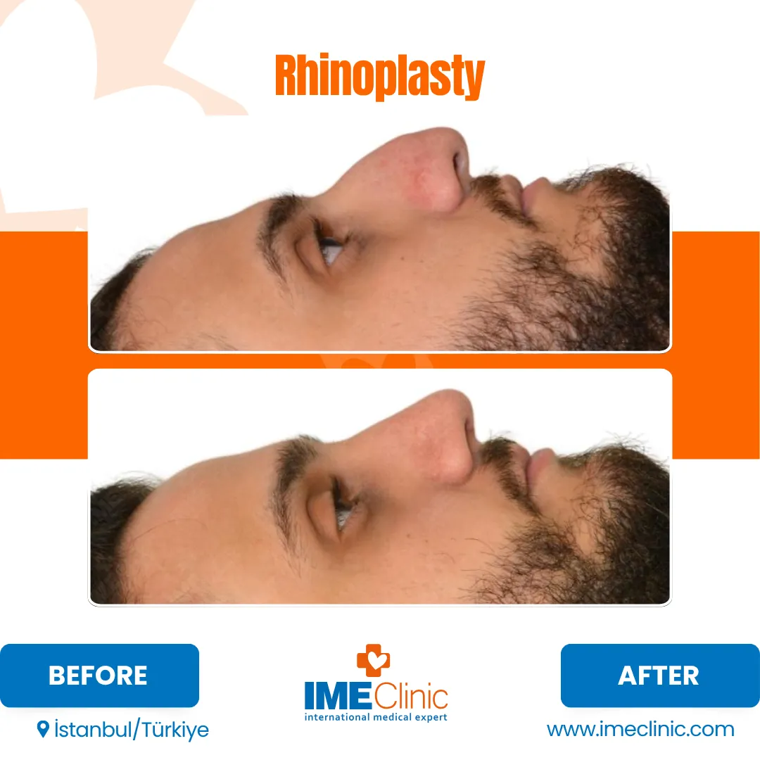 Side-by-side profile images of a mans face before and after rhinoplasty, showing a noticeable reduction in nasal hump and smoother nose contour. Before and After labels are at the bottom, with clinic details below.