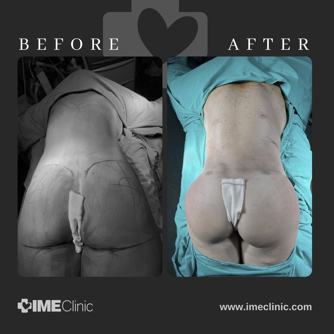 A before-and-after image of a persons back and buttocks showcases the transformative effects of a BBL. The left side, marked with guiding lines, contrasts with the right, displaying post-surgery results. Text reads Before on the left and After on the right, with IME Clinic at the bottom.