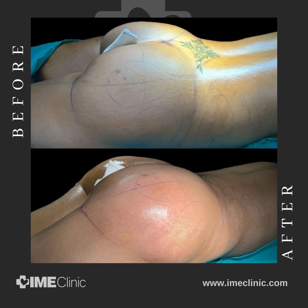 
                                Side-by-side images labeled Before and After depict the lower body of a person lying down. The Before image features pre-surgical markings and a tattoo, while the After image reveals a smoother appearance, highlighting the transformative effects of a BBL procedure.