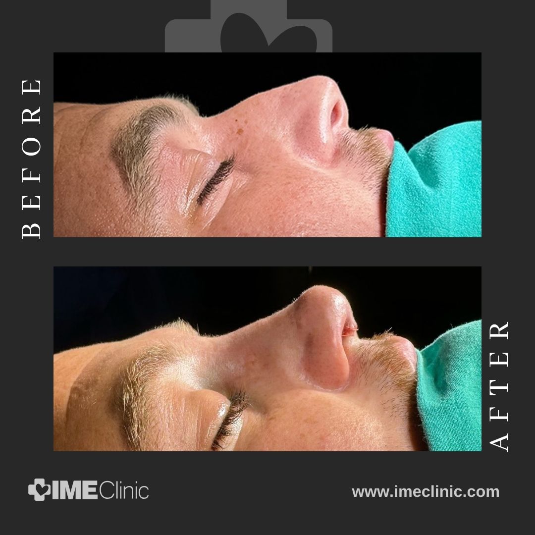 Side-by-side comparison of a person’s profile before and after rhinoplasty. The top image shows the before with a more rounded nose, while the after image at the bottom reveals a more defined nose shape. Text: IME Clinic and www.imeclinic.com.