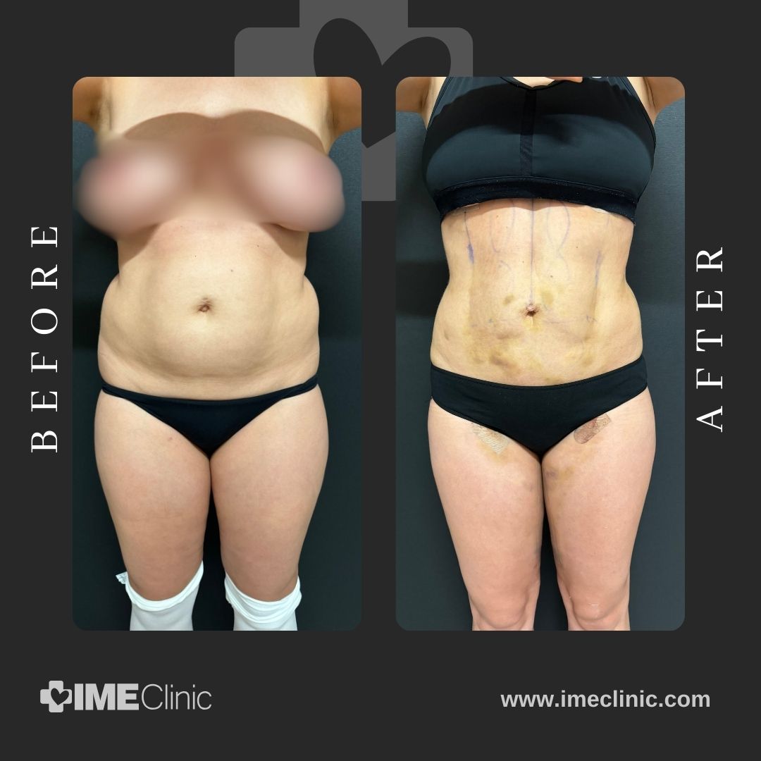 Two side-by-side images labeled Before and After illustrate the transformative effects of a tummy tuck, showcasing noticeable changes in the abdominal appearance.