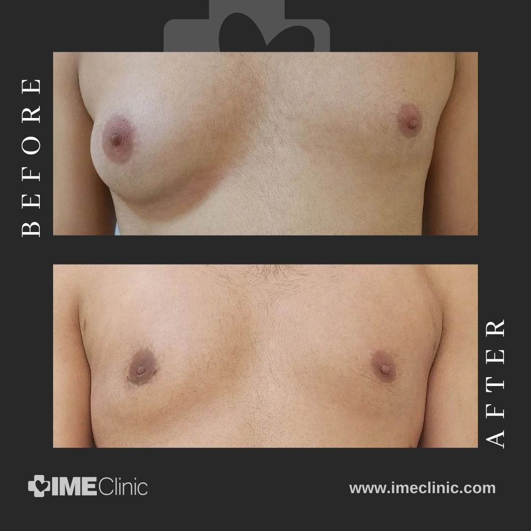 Before and after photos showcasing a gynecomastia transformation. The top image displays a fuller chest, while the bottom reveals a more contoured look. Text reads BEFORE and AFTER with IME Clinic branding, highlighting the powerful impact of specialized care.